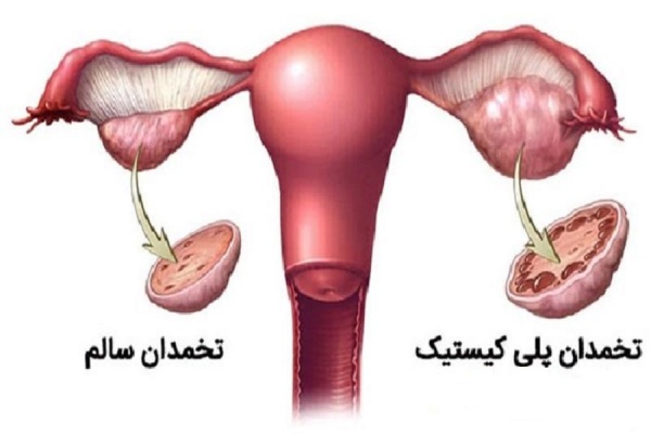 ضرورت آموزش بهداشت قاعدگی به دختران برای پیشگیری از ناباروری و بیماری‌های زنان