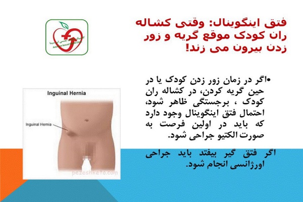 فتق اینگوینال: وقتی کشاله ران کودک موقع گریه و زور زدن بیرون می زند!